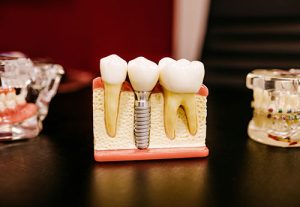 Odontología conservadora | Clínica Dental Feria