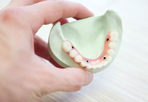 Prótesis dentales | Clínica Dental Feria